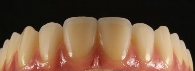 Prótese Sobre Implante